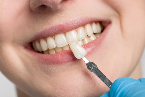 How Long Will Veneers Typically Last?
